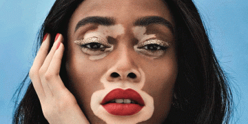 Winnie Harlow